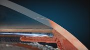 Primary Stair Step Self Sealing Incision
