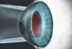 Laser surgery can reduce the need for daily medication