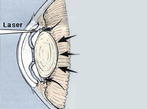 Laser iridotomy