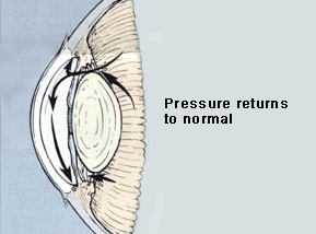 Final hole in iris to release pressure